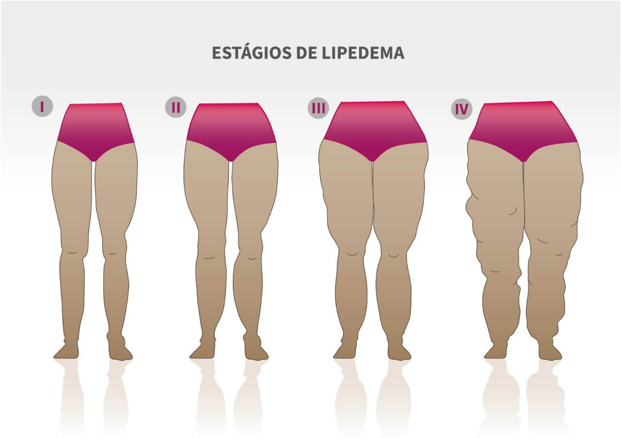 SOGESP - #Examina - Lipedema: saiba mais sobre essa condição que afeta