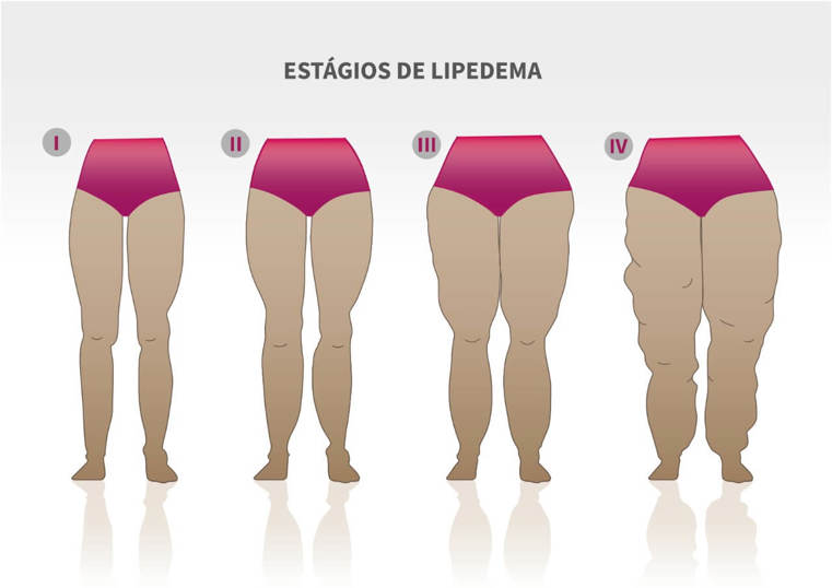 SOGESP - #Examina - Lipedema: saiba mais sobre essa condição que afeta pelo  menos 1 em cada 10 mulheres